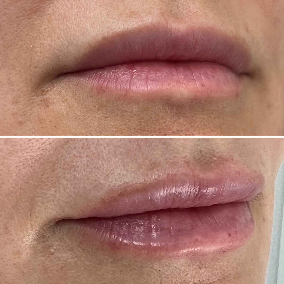 Dermal Fillers