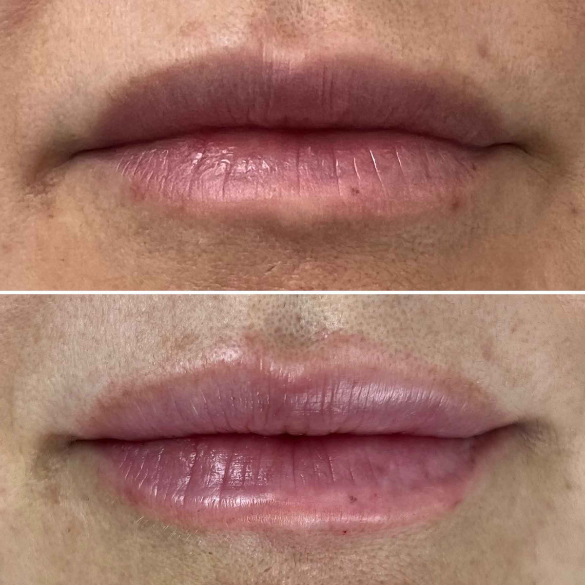 Dermal Fillers