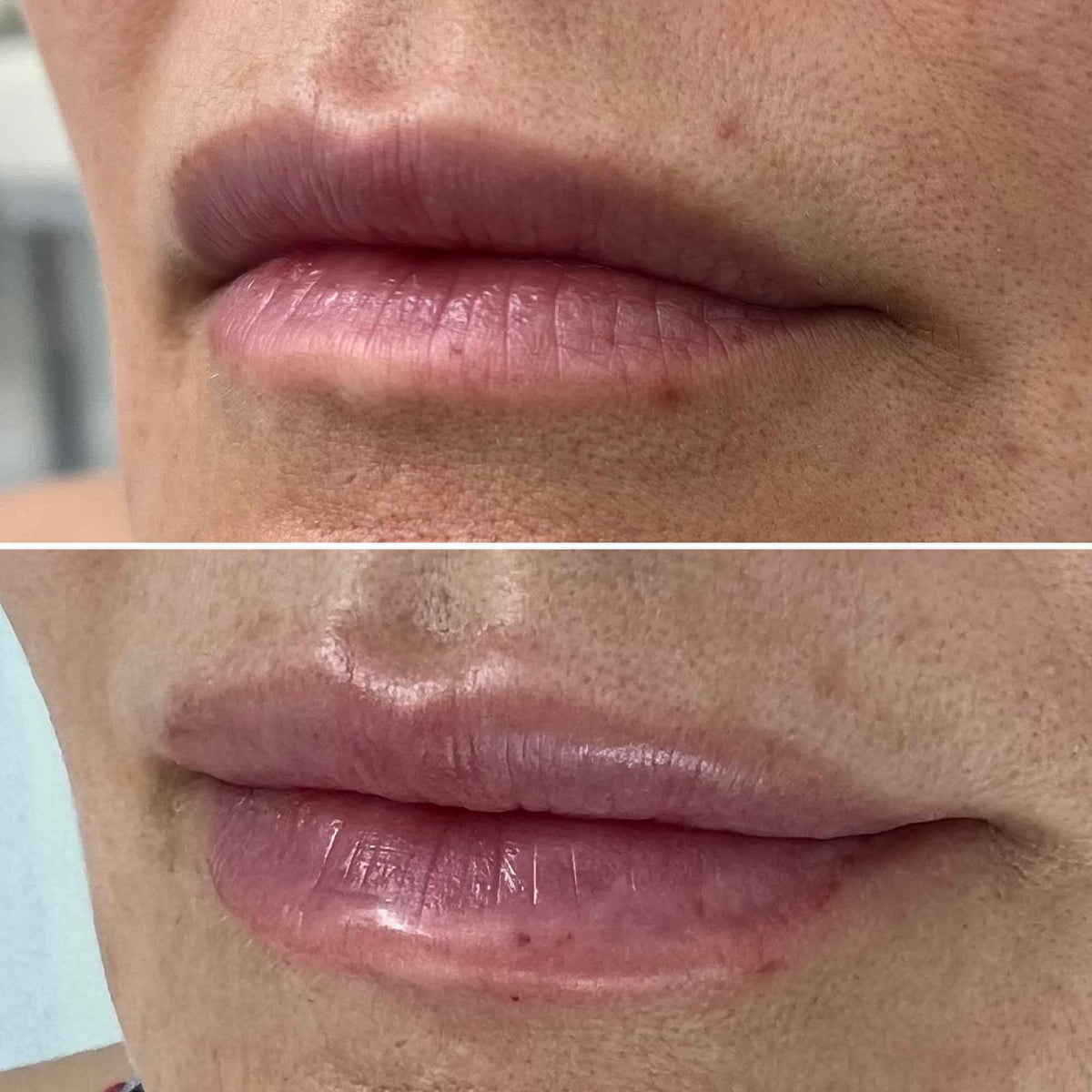 Dermal Fillers